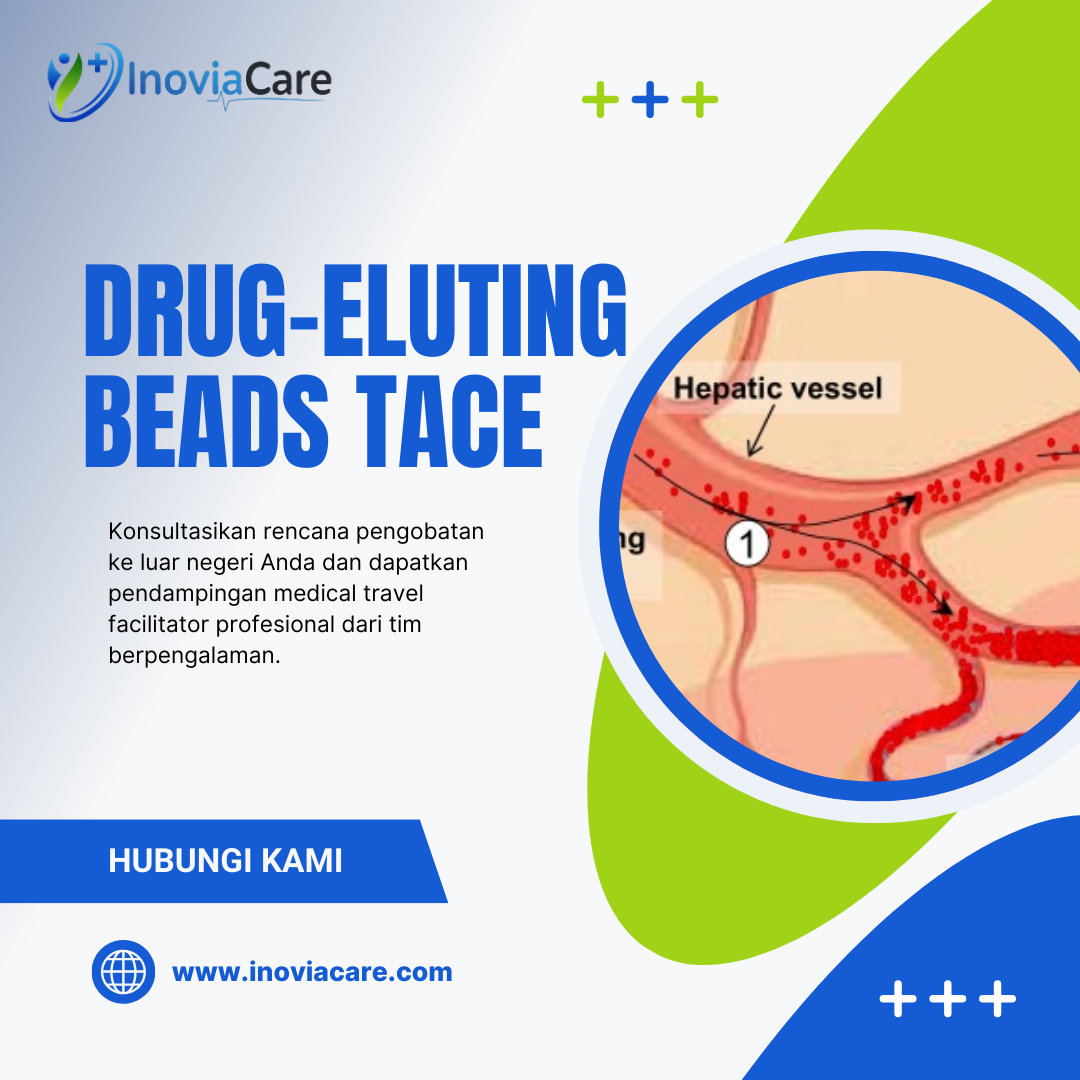 Drug-Eluting Beads TACE